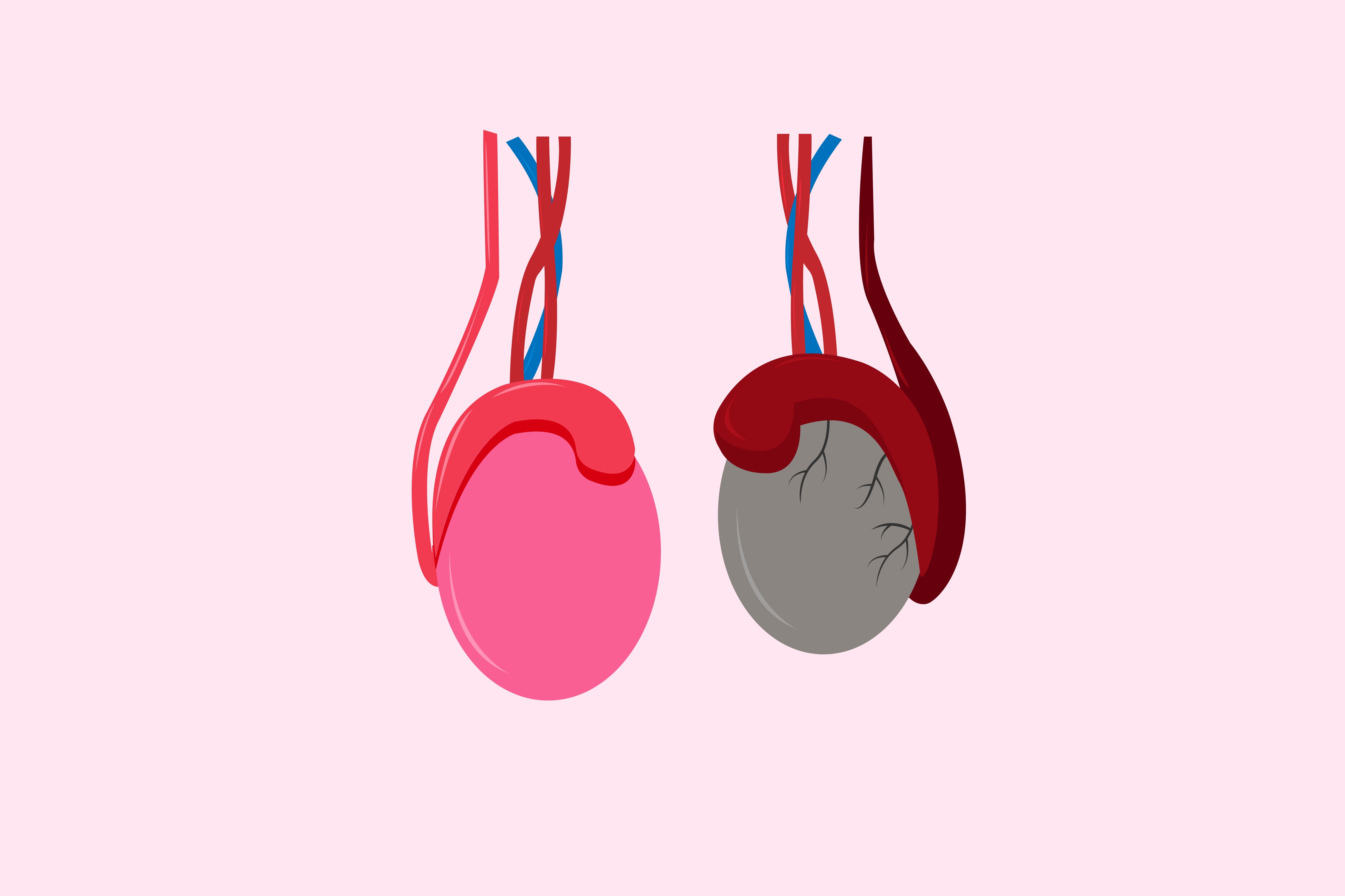 Tumores testiculares